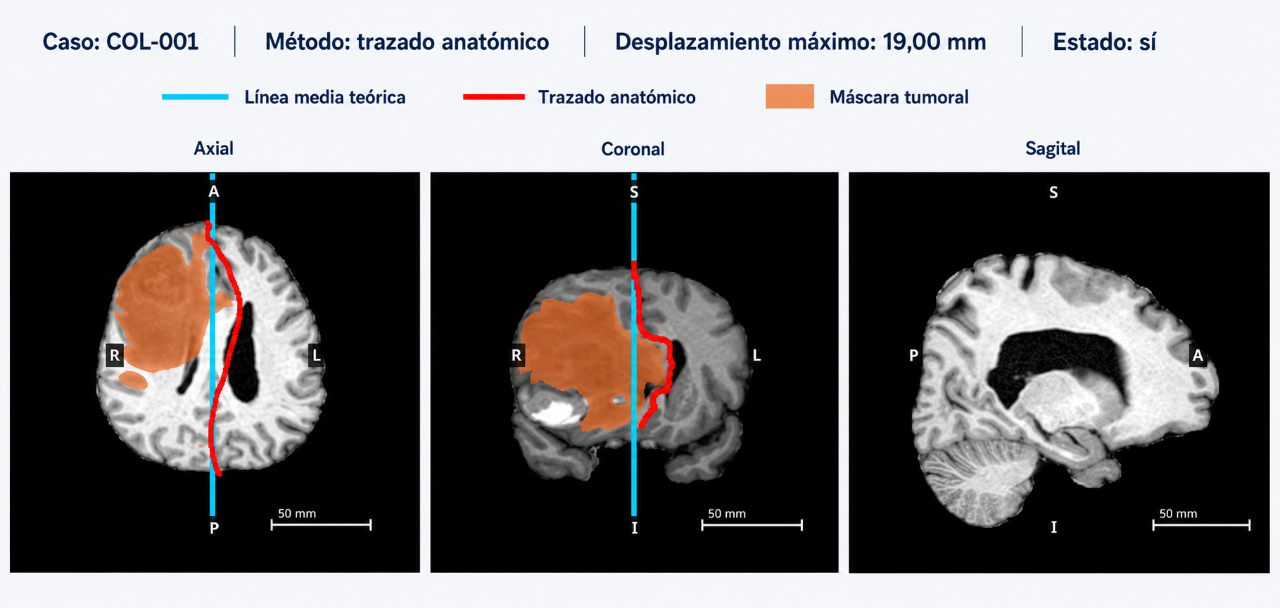 SGEM: referencia teórica y trazo anatómico en COL-001