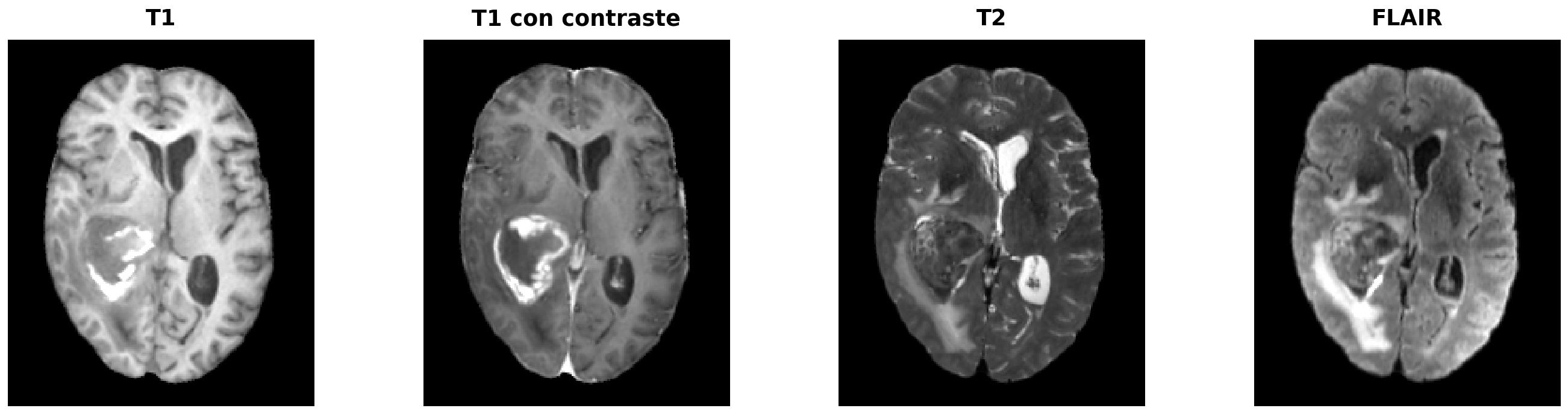 T1, T1 con contraste, T2 y FLAIR